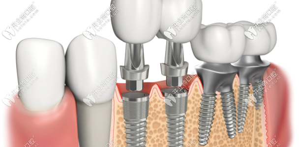 德國種植牙構(gòu)造