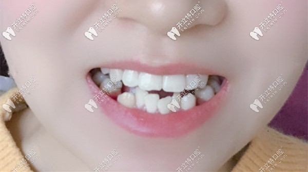 我做矯正前的牙齒樣子 我做矯正前的牙齒樣子