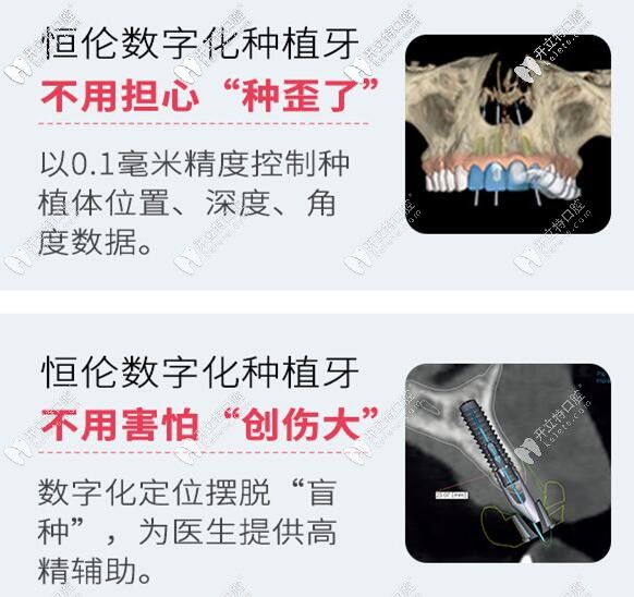 石家莊恒倫口腔數(shù)字化種植牙技術(shù) 石家莊恒倫口腔數(shù)字化種植牙技術(shù)