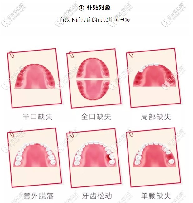 在惠州致美口腔做全口種植牙可享受到補(bǔ)貼3000-8000元