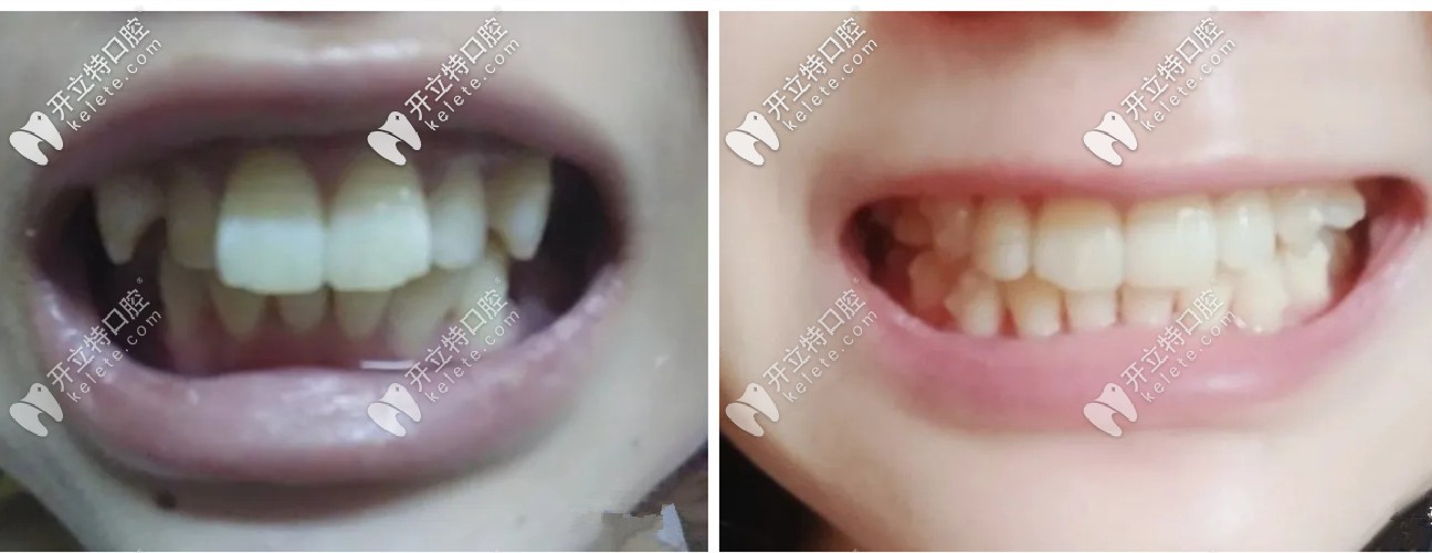 拔了4顆牙后做的隱適美，在濰坊戴隱形牙套的效果還不錯