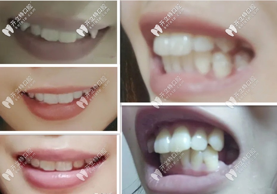 牙齒不同時(shí)期的變化圖