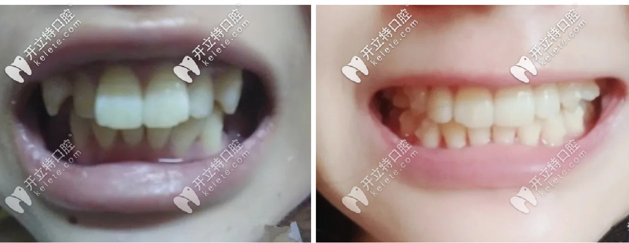 一年半的時(shí)間，牙套已經(jīng)變得<span style=