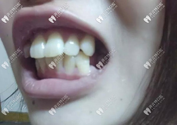 牙齒的側(cè)面照，外凸的厲害