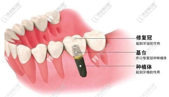 深圳柏齒康口腔進口種植牙