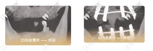 口內(nèi)全景片前后對(duì)比