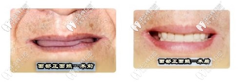 面部正面照術(shù)前術(shù)后對(duì)比