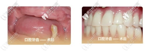 我75歲沒牙去做了全口all-on-4種植牙的經(jīng)歷，種牙過程很快