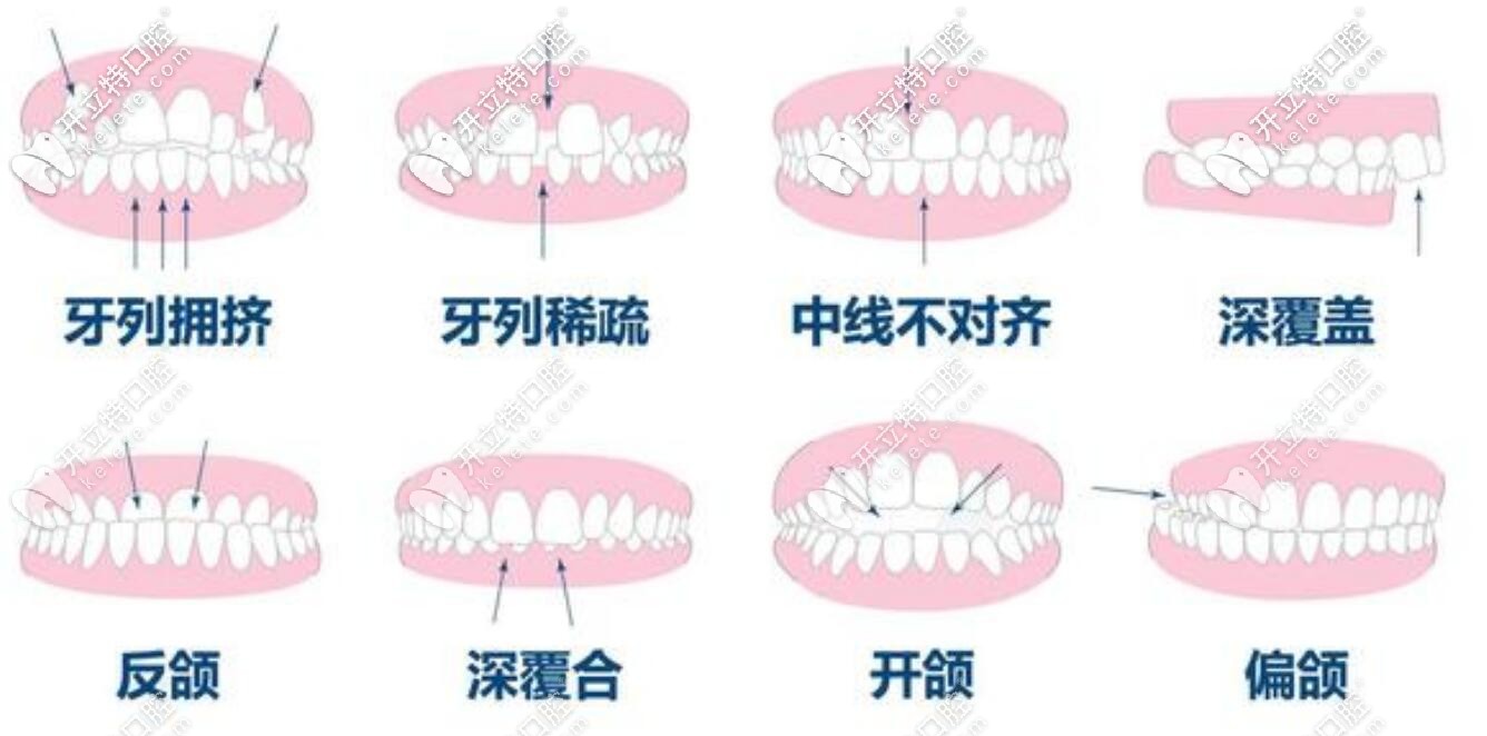 牙齒不齊的危害