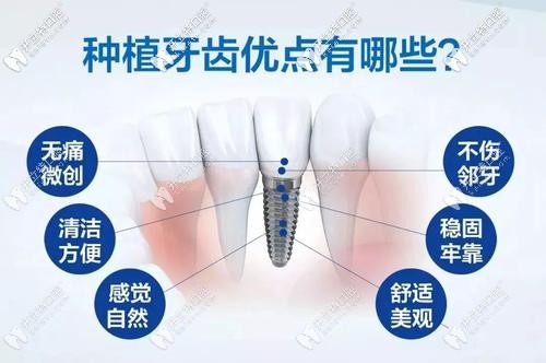 種植牙優(yōu)點(diǎn)