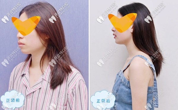 吳小姐在廣大口腔做正頜的前后圖