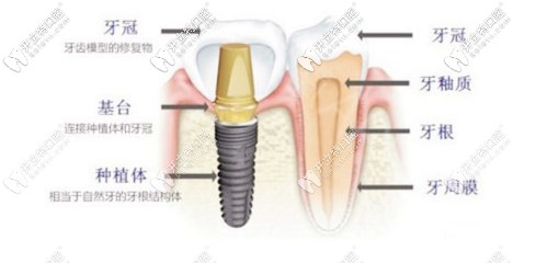 告訴你在南京江寧區(qū)卡瓦口腔做進(jìn)口種植牙的費(fèi)用是多少