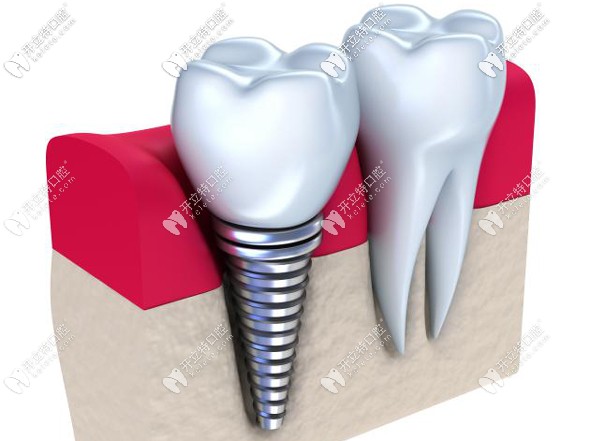 在廣州市做普通全口種植牙的價(jià)格參考