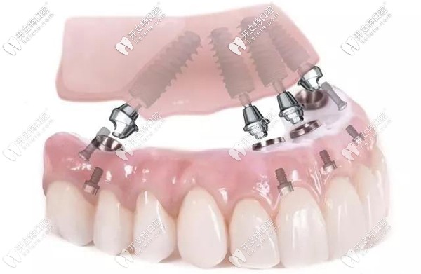 All-on-4全口種植技術(shù)及費(fèi)用