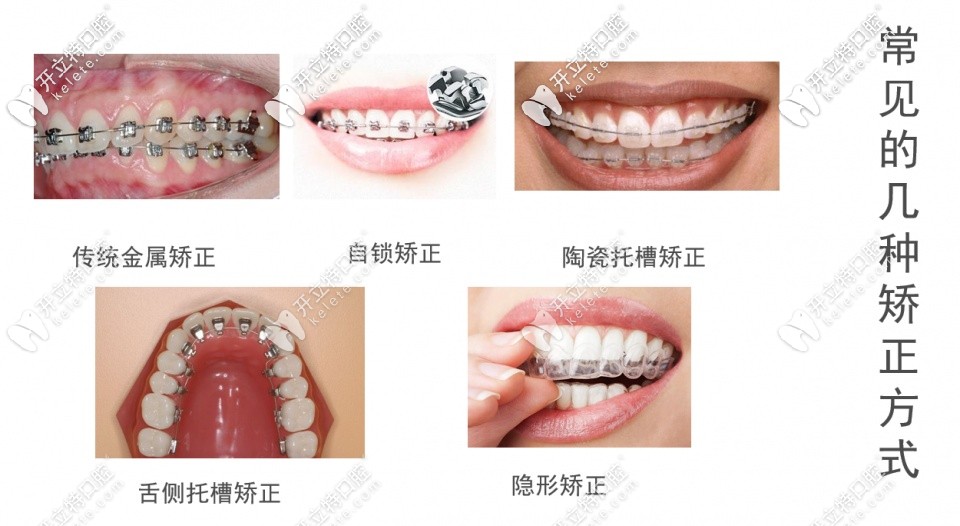 成人牙齒矯正器