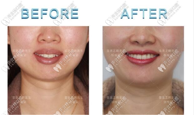 骨性I類(lèi)齙牙小姐姐矯正正臉<span style=