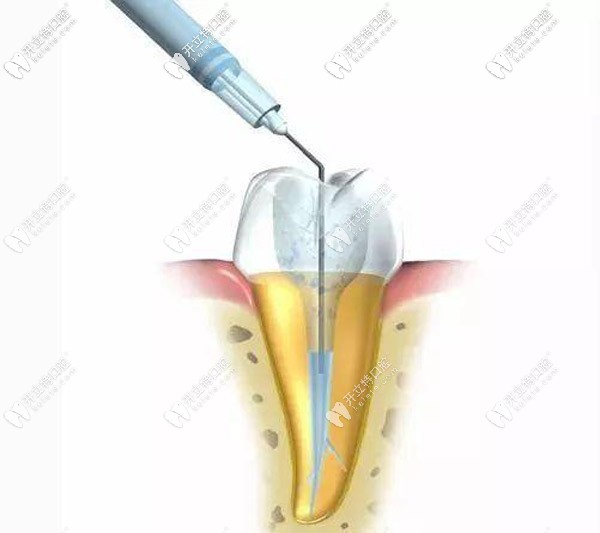 解析什么叫做根管治療