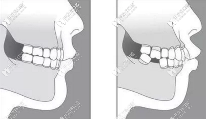 缺牙不能拖要及時醫(yī)治 缺牙不能拖要及時醫(yī)治