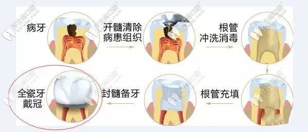 根管治療的步驟