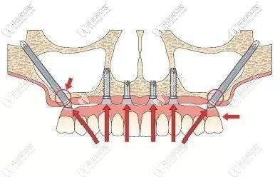 穿顴手術(shù)的示意圖
