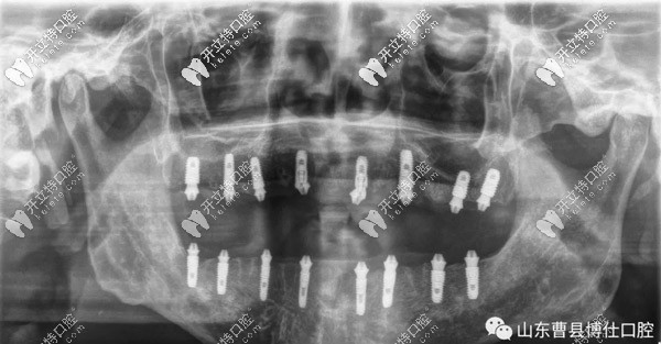 上下各植入8顆種植體