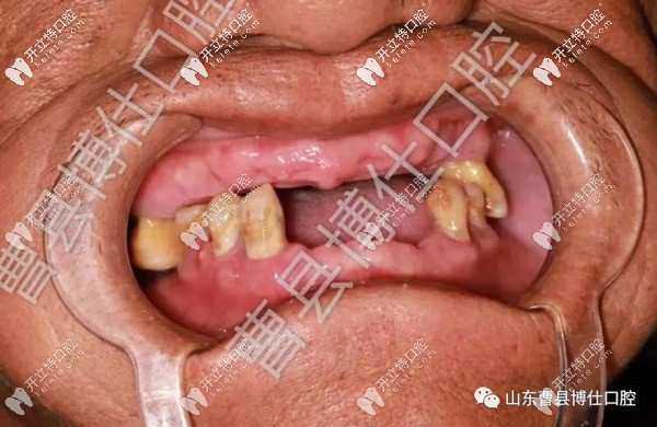 未做種植牙前的牙齒情況