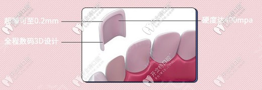 全瓷牙介紹 全瓷牙介紹