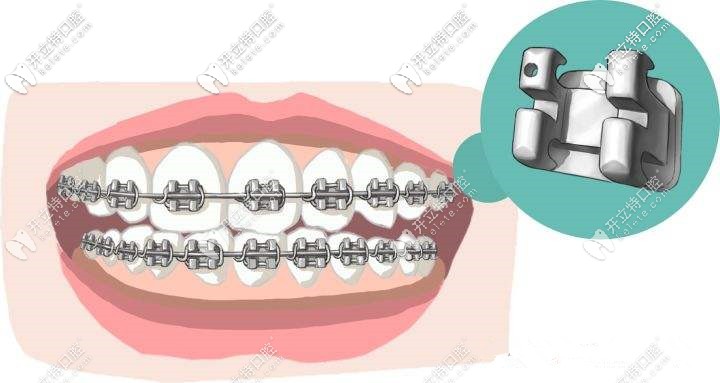 自鎖牙套的鎖扣