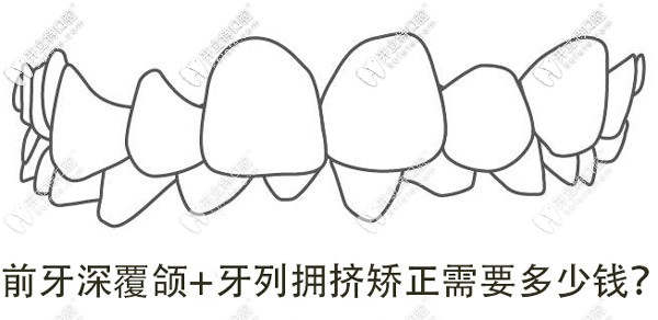 牙列擁擠+深覆合，想矯正牙齒做手術(shù)需要多少錢呢？
