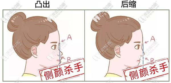 深覆合會(huì)導(dǎo)致臉型不好看