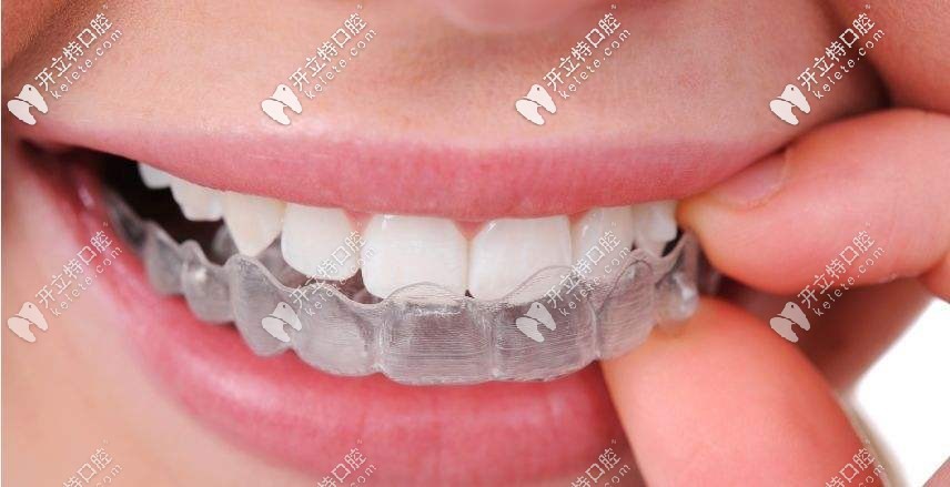全透明牙套佩戴上的樣子 全透明牙套佩戴上的樣子