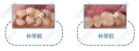 補(bǔ)牙前后對(duì)比