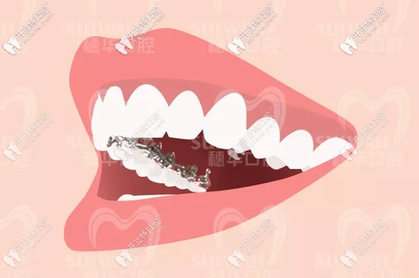 廣州穗華口腔引進3M Incognito黃金舌側(cè)矯治系統(tǒng)