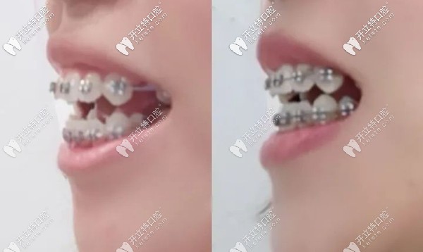 太原眾牙口腔牙齒矯正案例