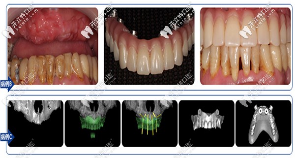 沈陽(yáng)盛大口腔全口、半口缺失案例