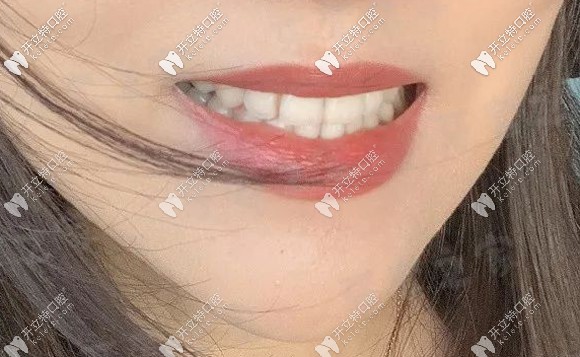 我在廣州穗華口腔戴陶瓷半隱形牙套750天后的矯正效果...