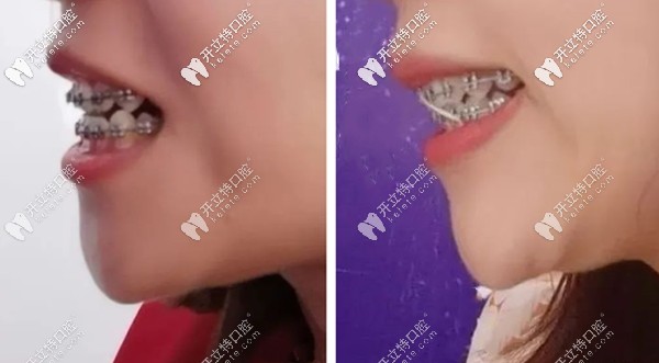 牙齒開頜矯正效果圖