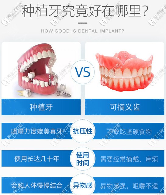 活動(dòng)假牙VS種植牙