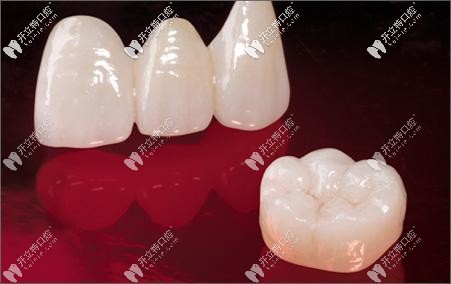 全瓷牙的樣子