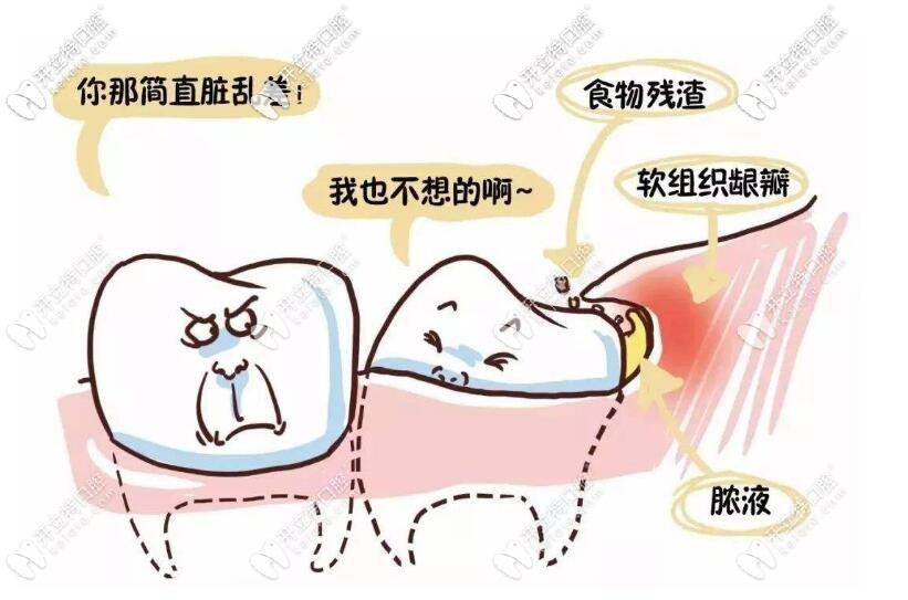 阻生智齒 阻生智齒