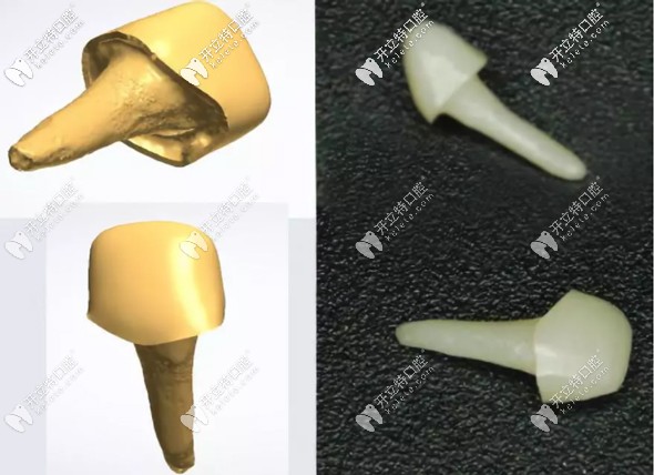 牙齒打樁做冠多少錢一顆