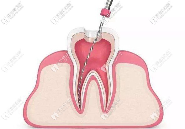 關于牙齒打樁做冠多少錢一顆,這有份詳細的樁核冠價格表哦