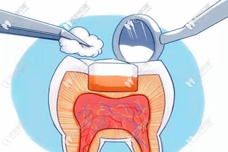 你關(guān)注的可樂麗菲露樹脂補(bǔ)牙多少錢一顆來了,附優(yōu)缺點(diǎn)哦