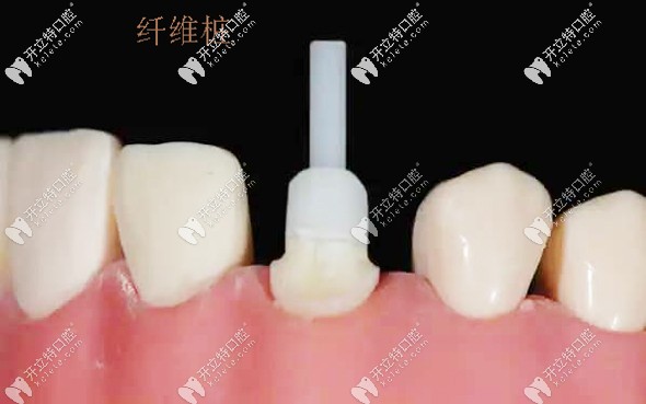 玻璃纖維樁示意圖