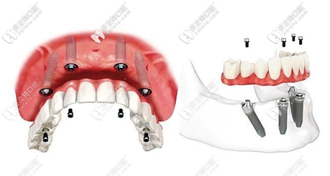 all-on-4種植技術(shù)
