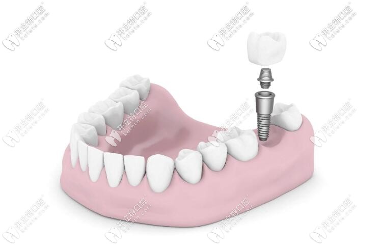 前牙種植和后牙種植的區(qū)別