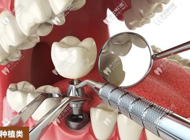 種植牙優(yōu)惠