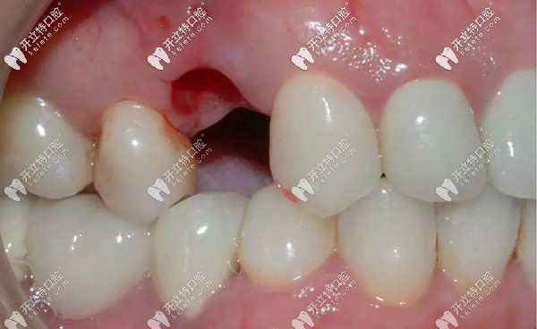 在忻州恒倫口腔做種植牙前的口內(nèi)照