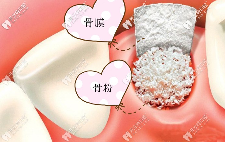 種植骨粉的價格是多少