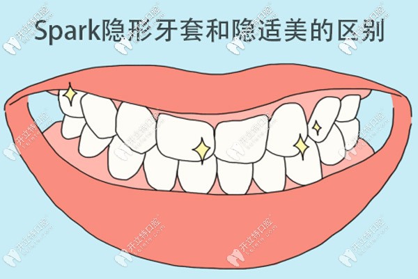 Spark隱形牙套和隱適美哪個好，區(qū)別是什么？